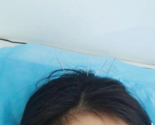 针灸 声带 明星,针灸助力明星声带康复之路